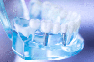 Dental clear blueish jaw model with dental tooth implant.