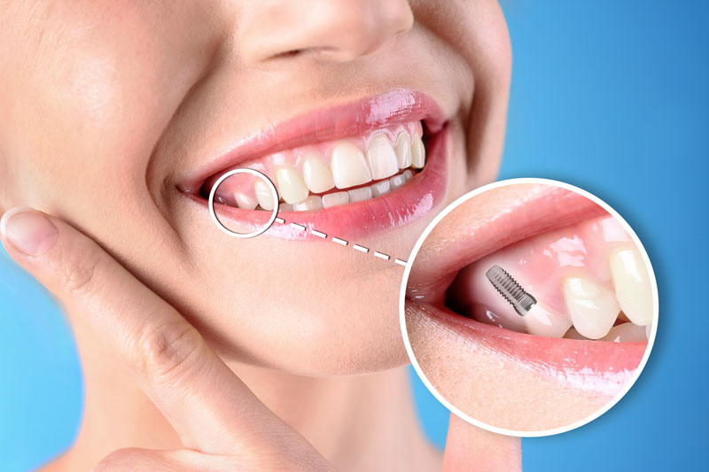 Female smiling with a diagram showing where her dental implant is at; blue background.