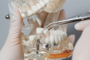 Photo of a doctor holding and working on a clear jaw prosthesis with an implant in it.