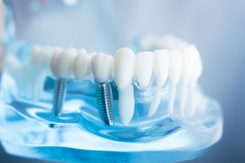 see through model of a jaw with 2 dental implants placed into it